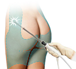 liposuzione lipolaser system