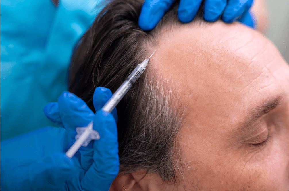 capelli diradati - equipe estetica