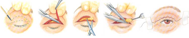 chirurgia-estetica-blefaroplastica-tecnica-1